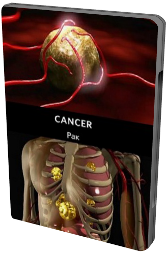 Рак (2 Серии) / Cancer DVO
