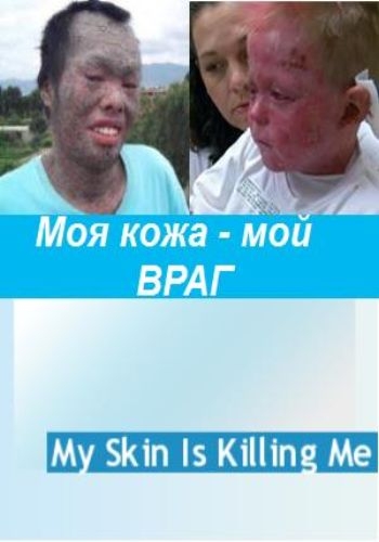 Моя кожа меня убивает / My Skin Is Killing Me VO