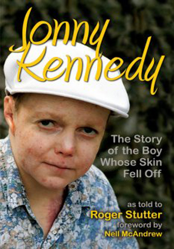 Мальчик, который остался без кожи / The boy whose skin fell off